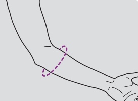 Orteza de cot epicondilita, PREMIUM